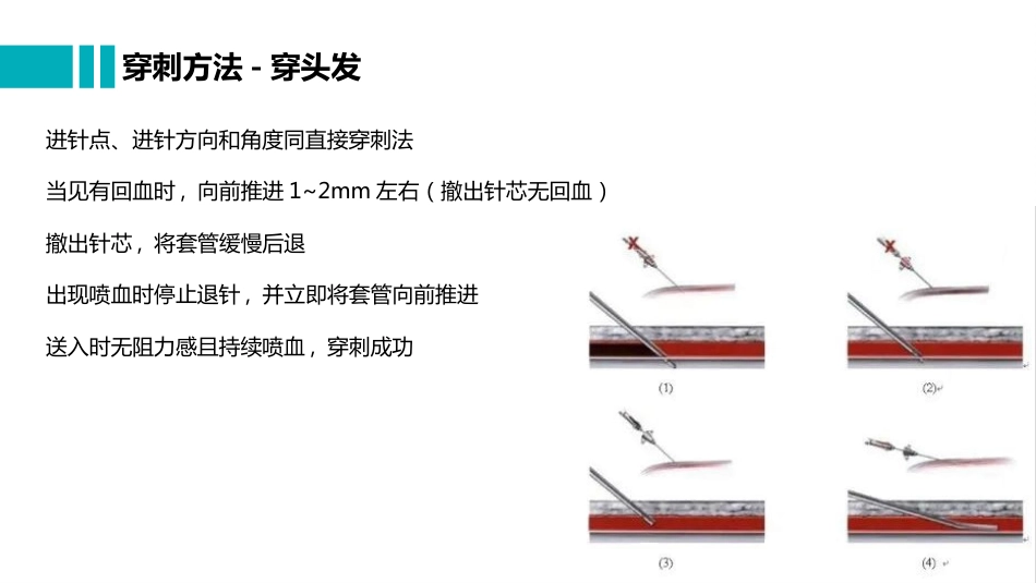 桡动脉穿刺置管操作与压力监测_第9页
