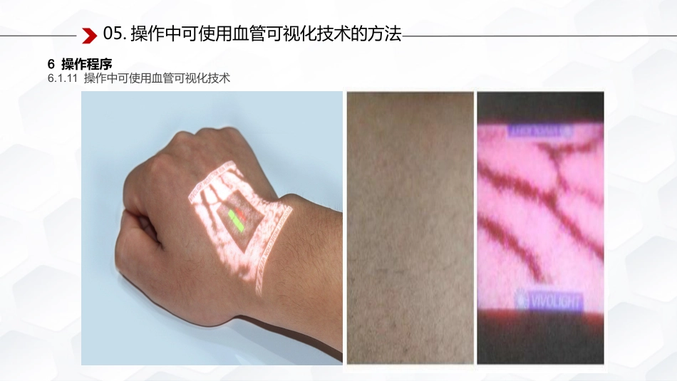 静脉治疗护理技术操作标准解读_第10页