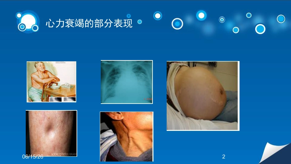 心衰患者容量管理培训课件_第2页