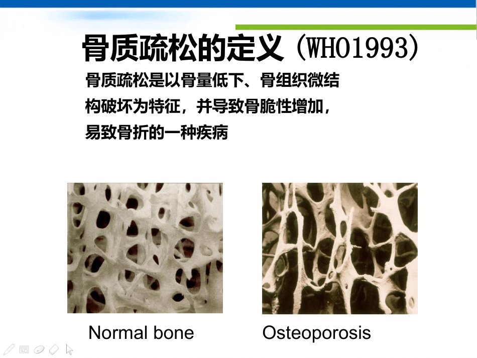 骨质疏松诊治及中医药_第2页