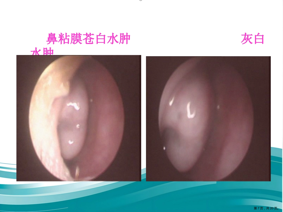 过敏性鼻炎的中医药防治_第7页