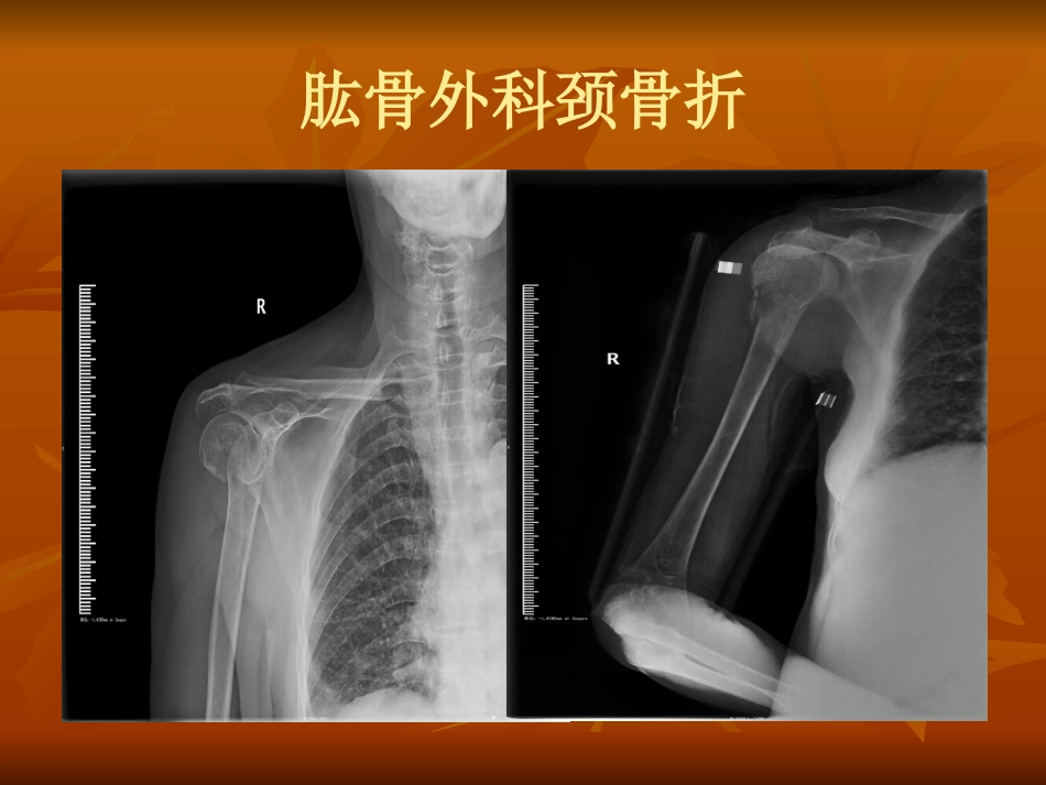 肱骨外科颈骨折中医诊疗方案_第4页