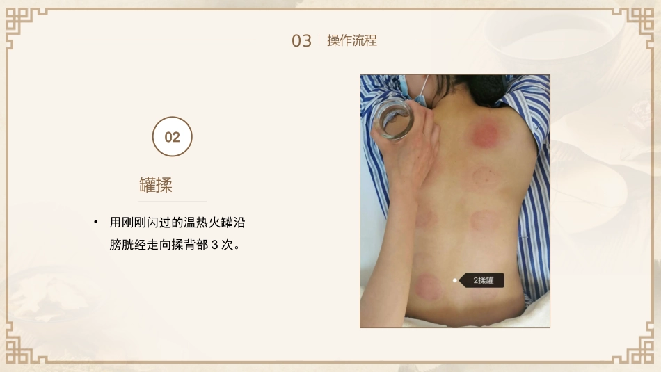 中医治疗：平衡火罐_第13页