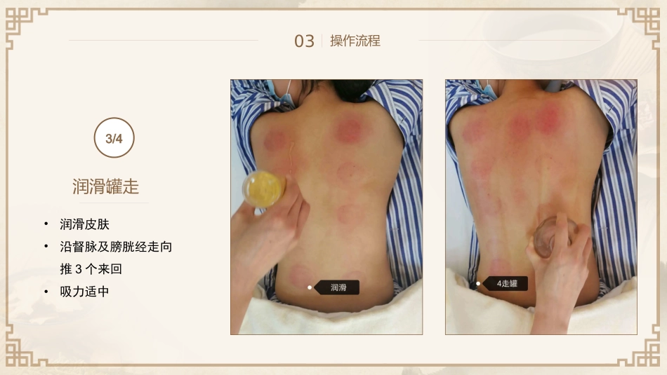 中医治疗：平衡火罐_第14页