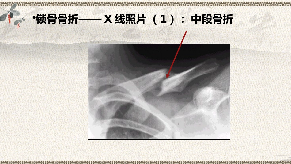 中医治疗：上肢骨折_第11页