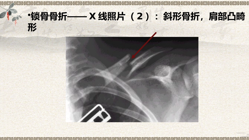 中医治疗：上肢骨折_第12页