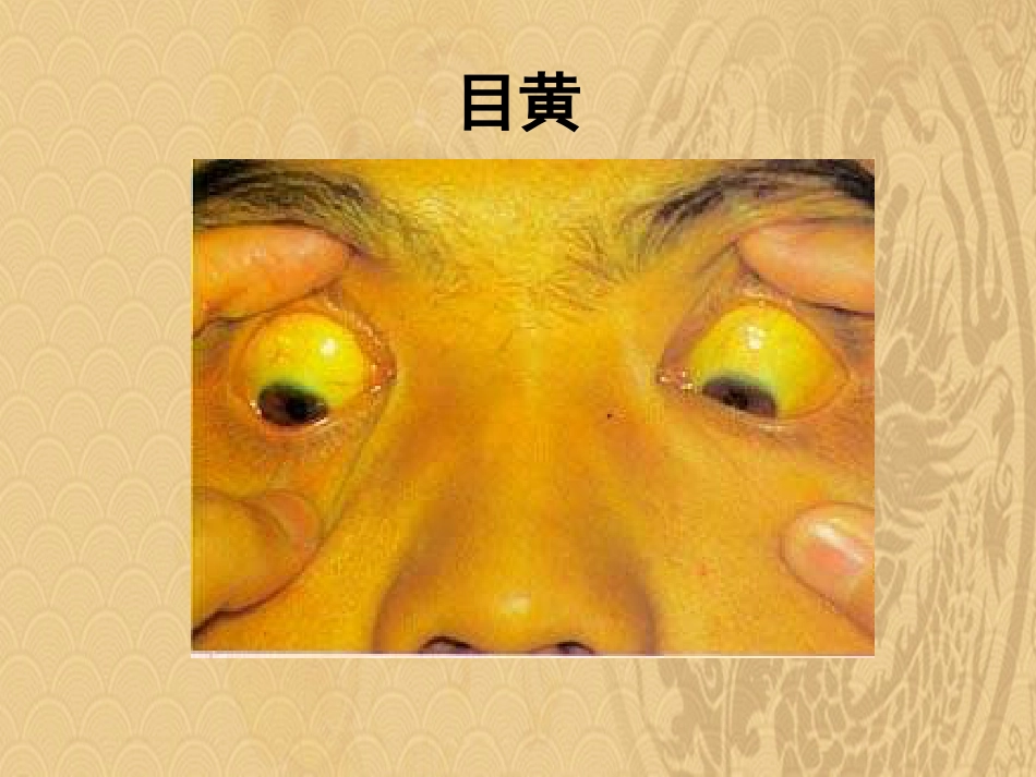 黄疸中医内科学2021_第3页