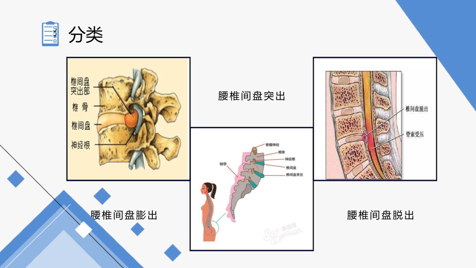 中医护理：腰椎间盘突出症护理_第7页