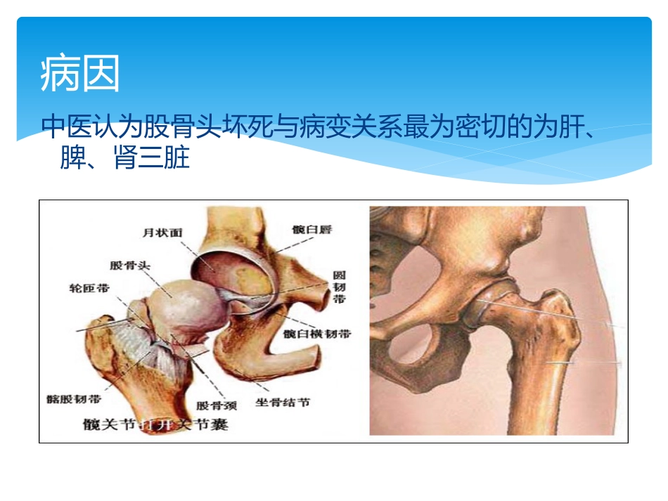 股骨头坏死中医辨证_第4页