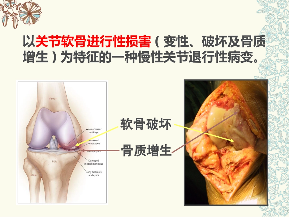 骨关节炎(中医药大学)_第5页
