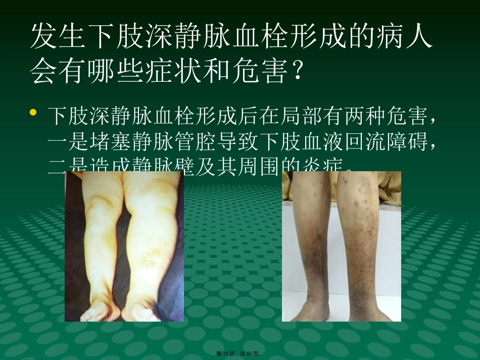静脉血栓中医(与“静脉”相关共50张)_第10页