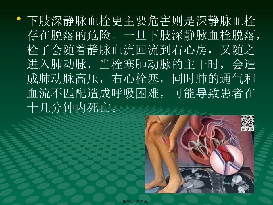 静脉血栓中医(与“静脉”相关共50张)_第14页