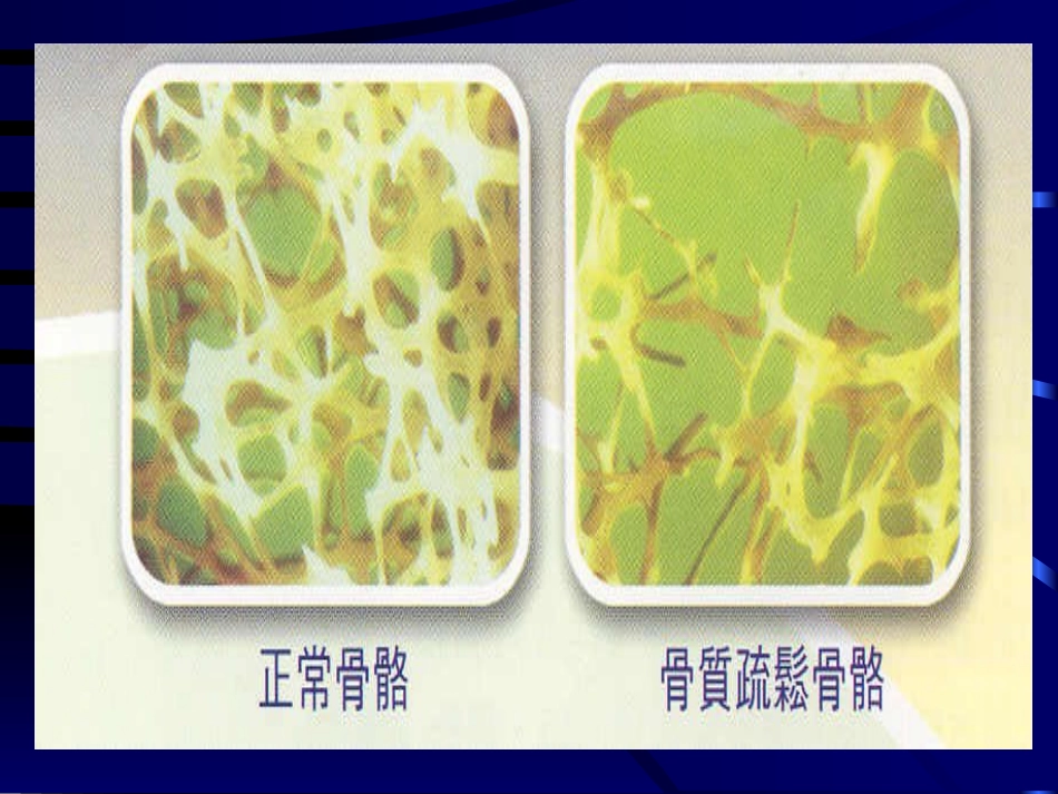 骨质疏松的中医药治疗PPT参考幻灯片_第6页