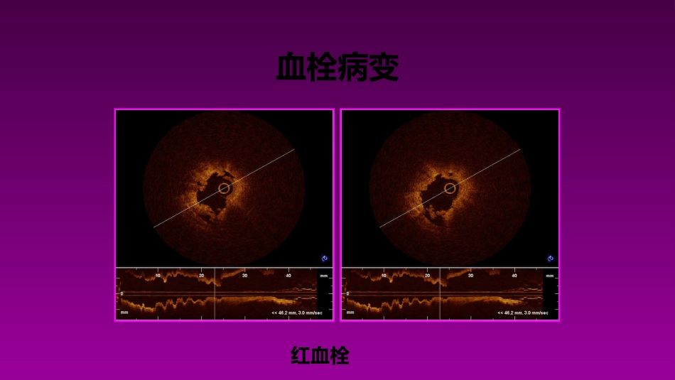 医学大赛一等奖《急性心肌梗死的治疗原则(AMI)》讲课课件_第10页