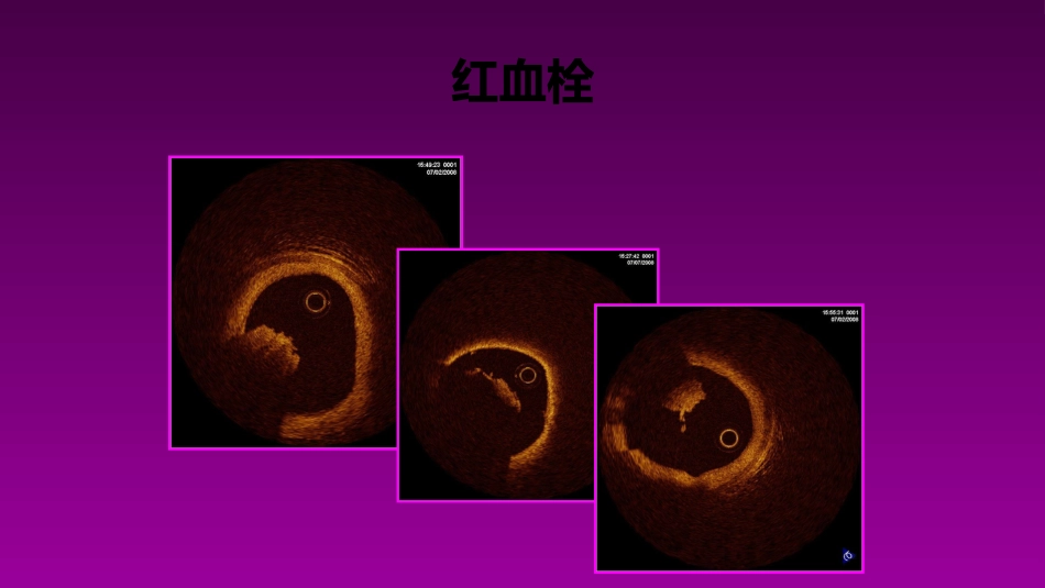 医学大赛一等奖《急性心肌梗死的治疗原则(AMI)》讲课课件_第11页