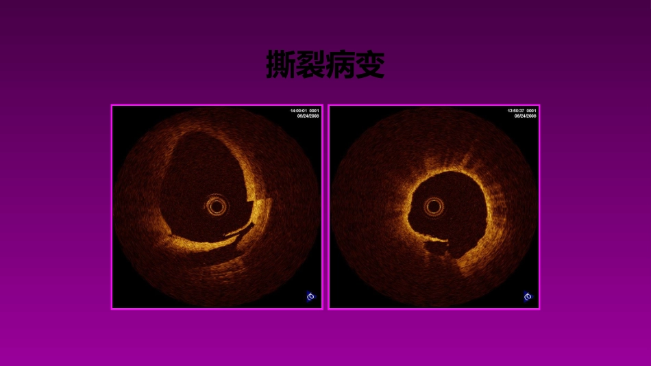 医学大赛一等奖《急性心肌梗死的治疗原则(AMI)》讲课课件_第12页