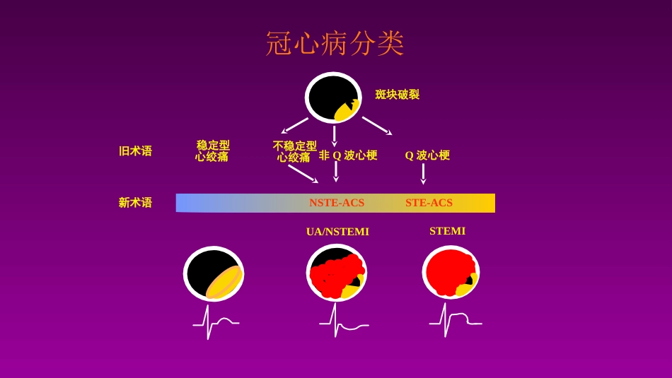 医学大赛一等奖《急性心肌梗死的治疗原则(AMI)》讲课课件_第3页
