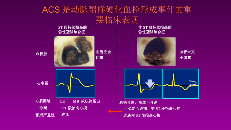 医学大赛一等奖《急性心肌梗死的治疗原则(AMI)》讲课课件_第4页