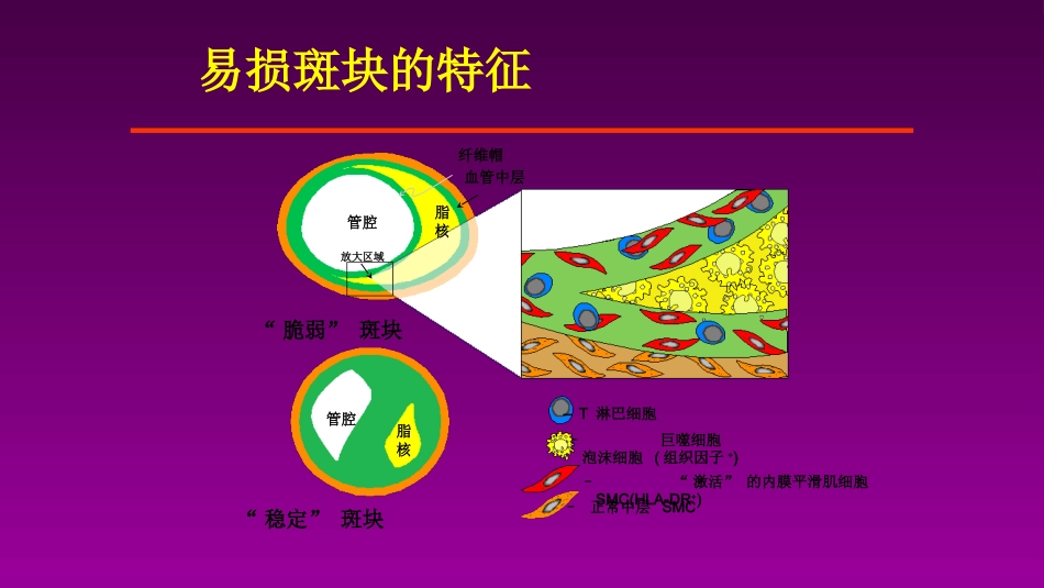 医学大赛一等奖《急性心肌梗死的治疗原则(AMI)》讲课课件_第5页