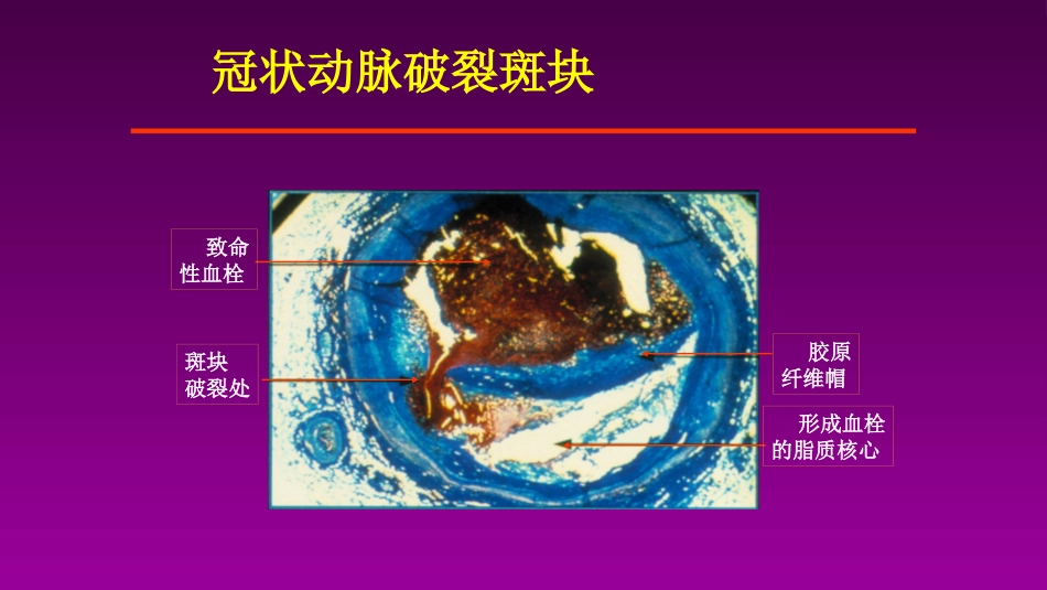 医学大赛一等奖《急性心肌梗死的治疗原则(AMI)》讲课课件_第6页