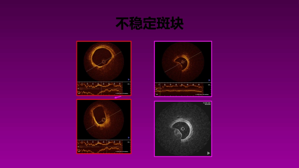医学大赛一等奖《急性心肌梗死的治疗原则(AMI)》讲课课件_第7页