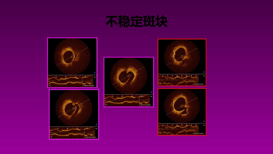 医学大赛一等奖《急性心肌梗死的治疗原则(AMI)》讲课课件_第8页