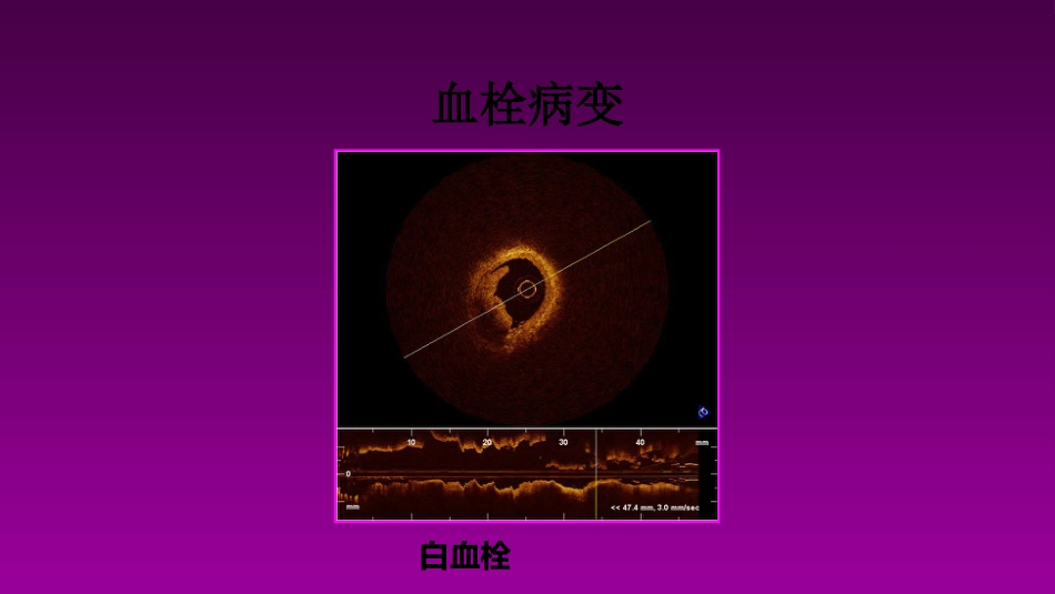 医学大赛一等奖《急性心肌梗死的治疗原则(AMI)》讲课课件_第9页