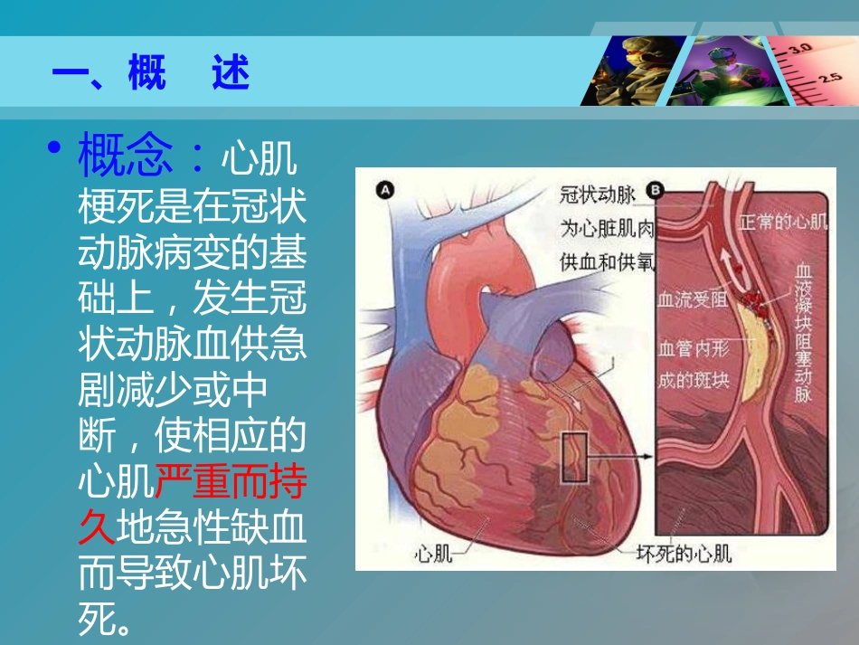 全国“创新杯”医药卫生类类说课大赛课件特等奖作品：心肌梗死课件_第4页