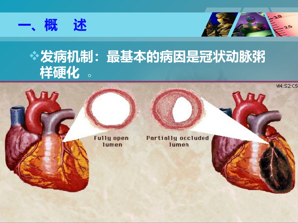 全国“创新杯”医药卫生类类说课大赛课件特等奖作品：心肌梗死课件_第6页