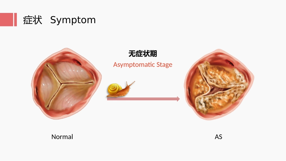 北京高校青年教师教学比赛获奖课件-医学类-主动脉瓣狭窄_第11页
