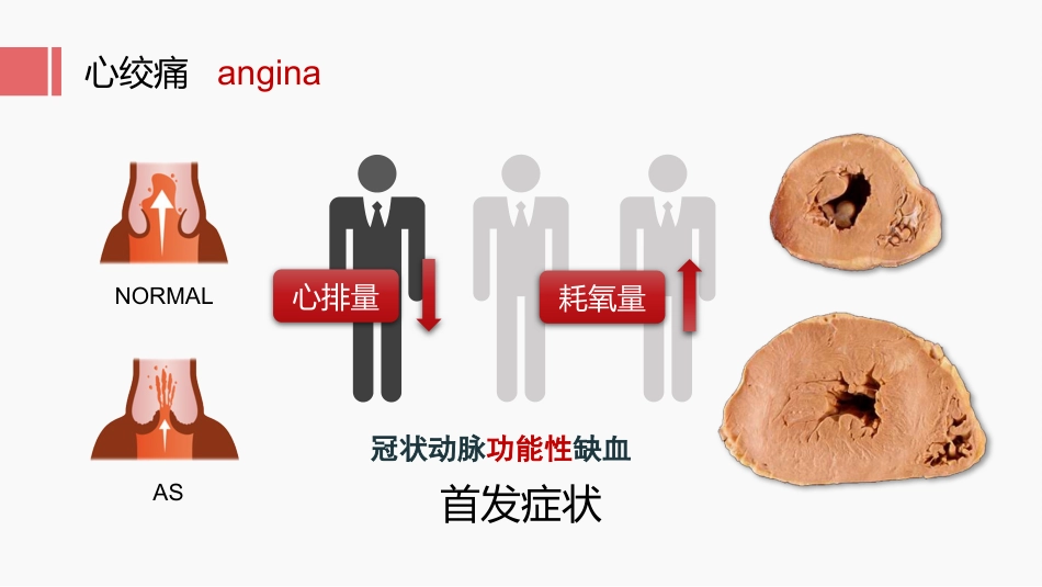 北京高校青年教师教学比赛获奖课件-医学类-主动脉瓣狭窄_第14页