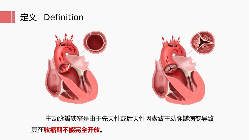 北京高校青年教师教学比赛获奖课件-医学类-主动脉瓣狭窄_第6页