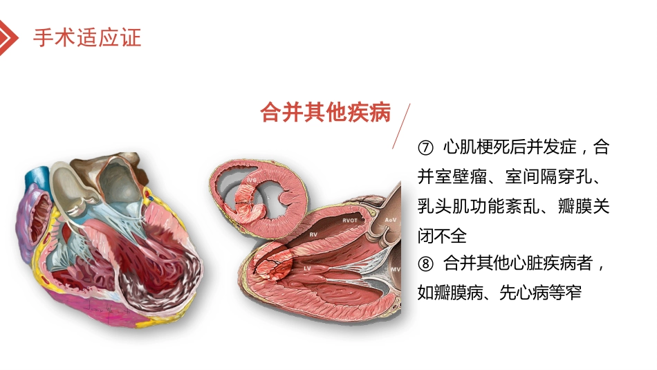 北京高校青年教师教学比赛获奖课件-医学类-冠心病的外科治疗_第12页