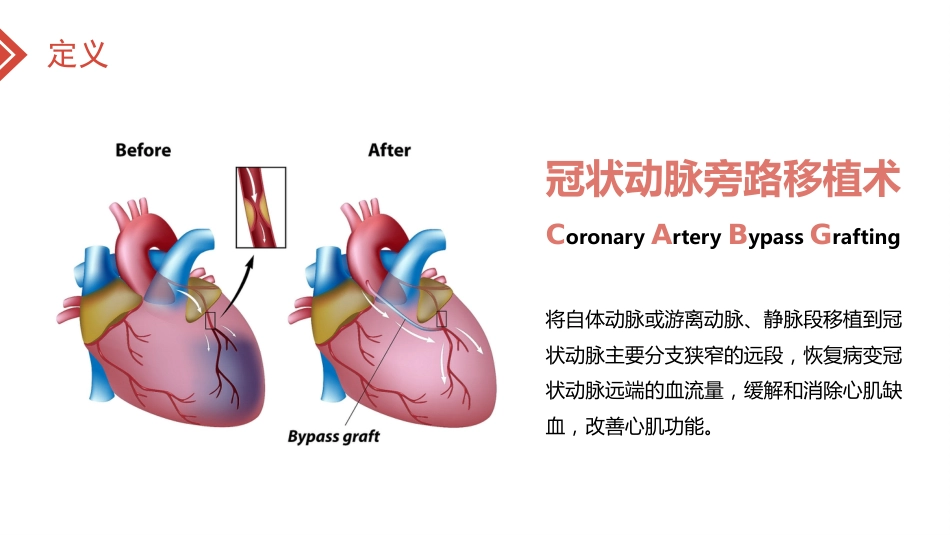 北京高校青年教师教学比赛获奖课件-医学类-冠心病的外科治疗_第7页