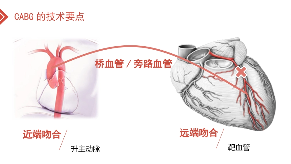 北京高校青年教师教学比赛获奖课件-医学类-冠心病的外科治疗_第8页