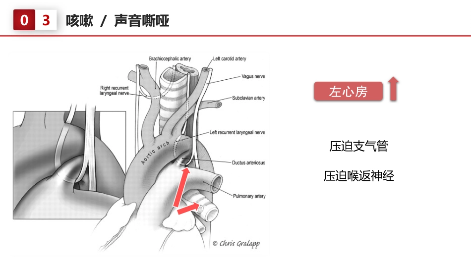 北京高校青年教师教学比赛获奖课件-医学类-二尖瓣狭窄_第15页