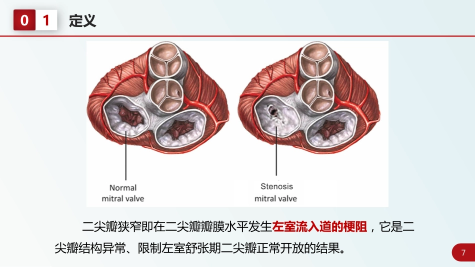 北京高校青年教师教学比赛获奖课件-医学类-二尖瓣狭窄_第7页