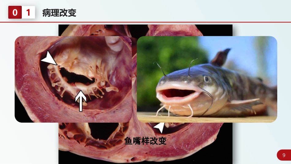 北京高校青年教师教学比赛获奖课件-医学类-二尖瓣狭窄_第9页