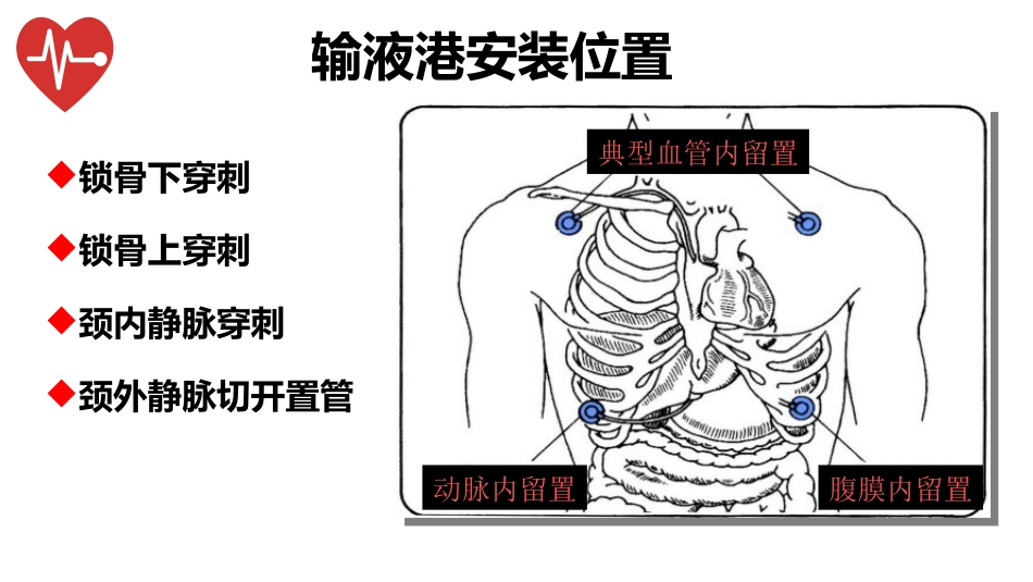 输液港的植入技术与维护_第11页