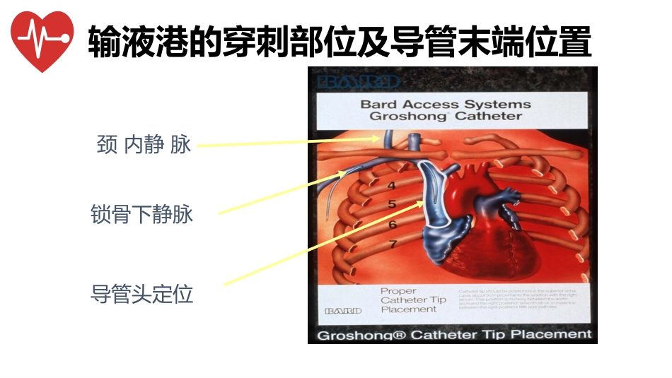 输液港的植入技术与维护_第12页