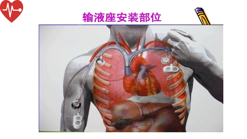 输液港的植入技术与维护_第13页