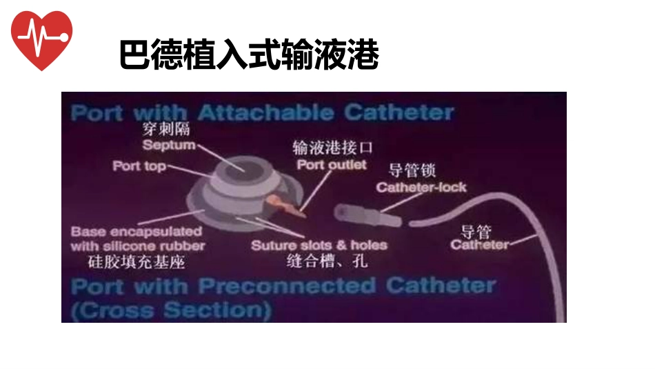 输液港的植入技术与维护_第6页
