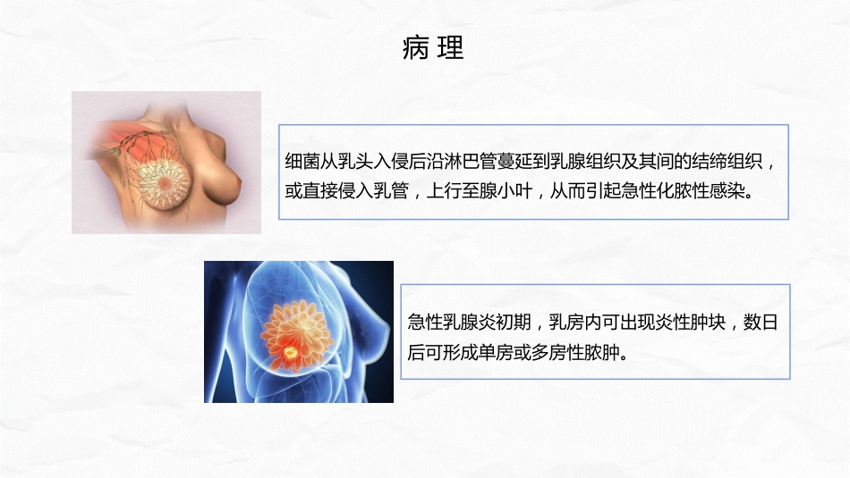 急性乳腺炎护理_第8页