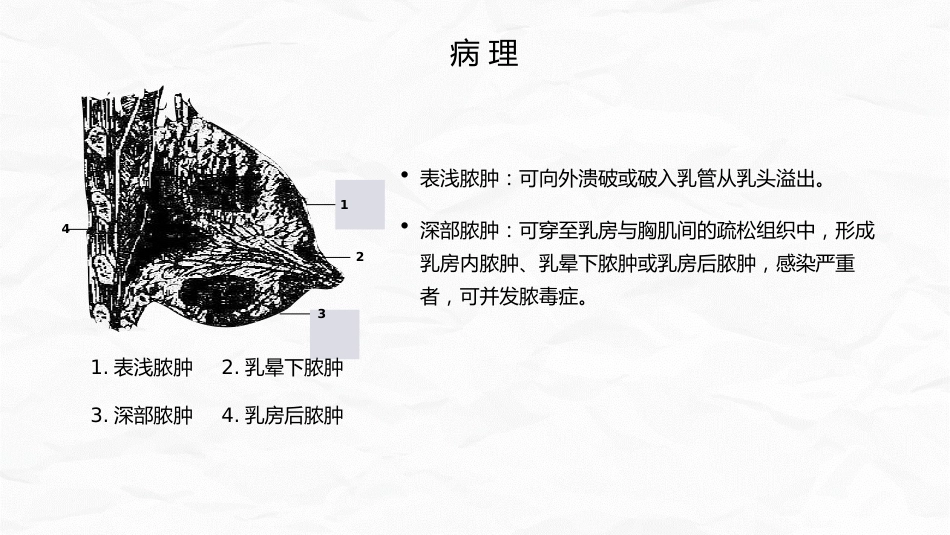 急性乳腺炎护理_第9页