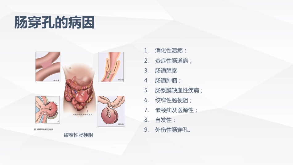 肠穿孔的护理学习_第6页