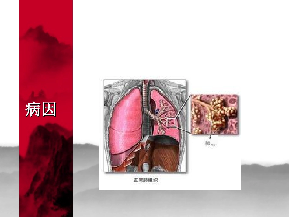ARDS护理查房_第3页