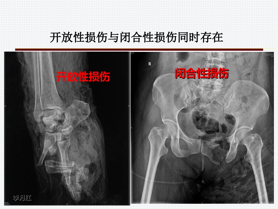05.多发伤的特点与救治原则_第13页