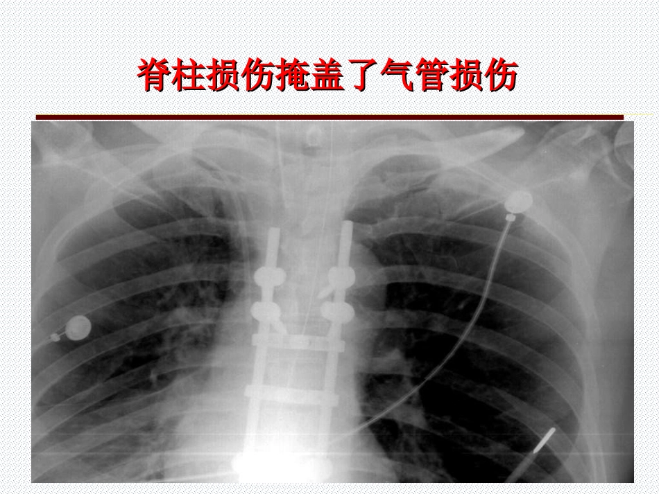 05.多发伤的特点与救治原则_第14页