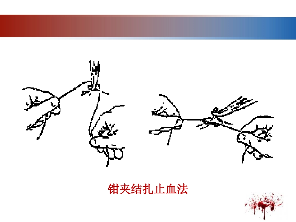 28.开放性伤口的止血技术_第10页