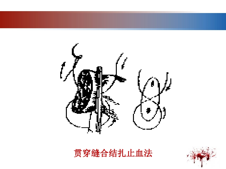 28.开放性伤口的止血技术_第11页